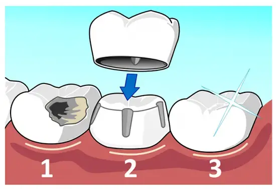 Cartoon of dental implants.