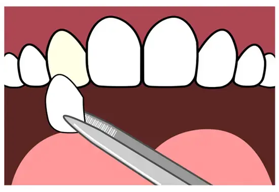 Cartoon of a dental veneer being applied to a discoloured tooth.