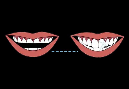 Cartoon representing worn down teeth