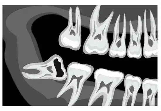 Cartoon of an xray on the jaw
